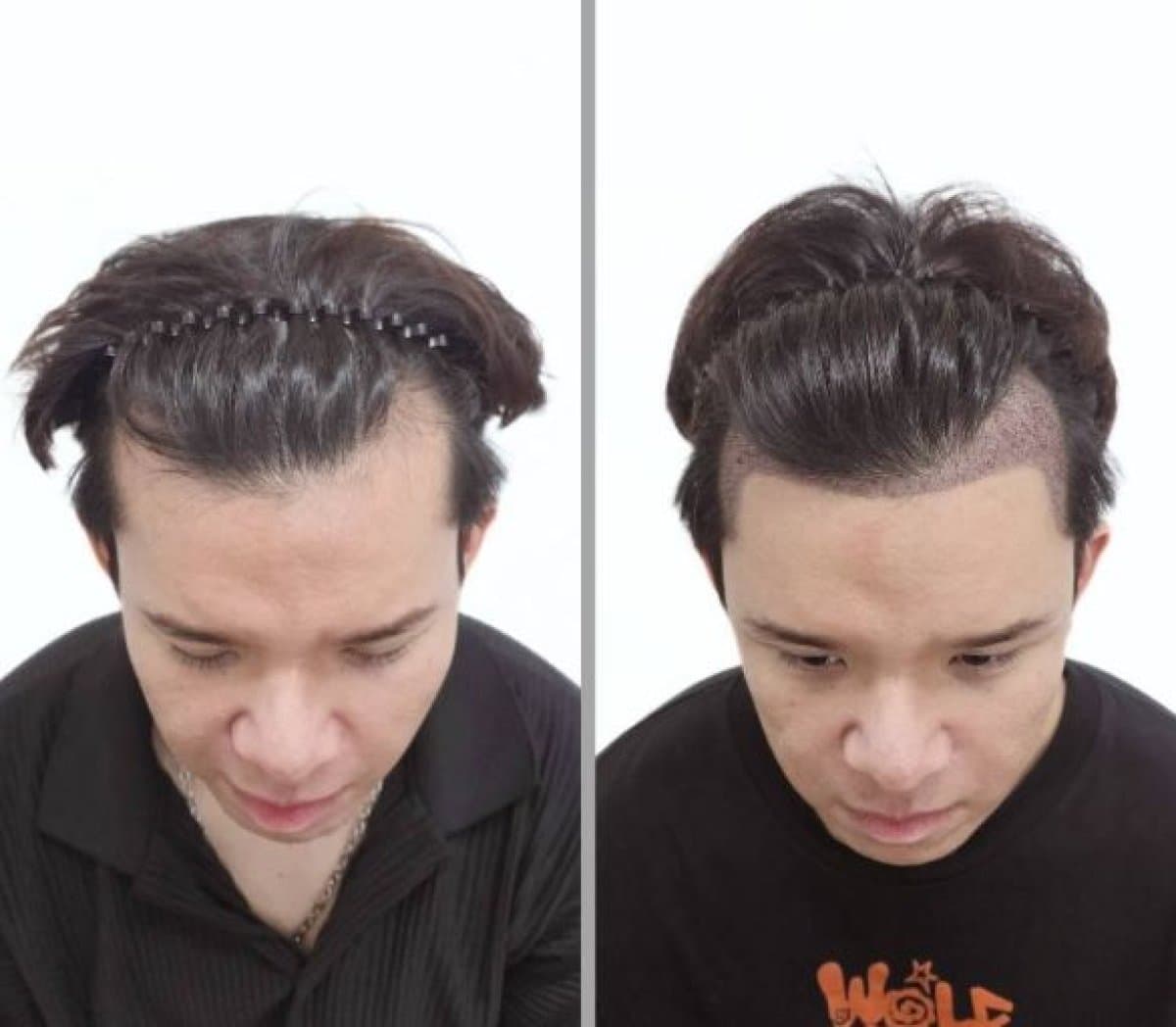 hair transplant