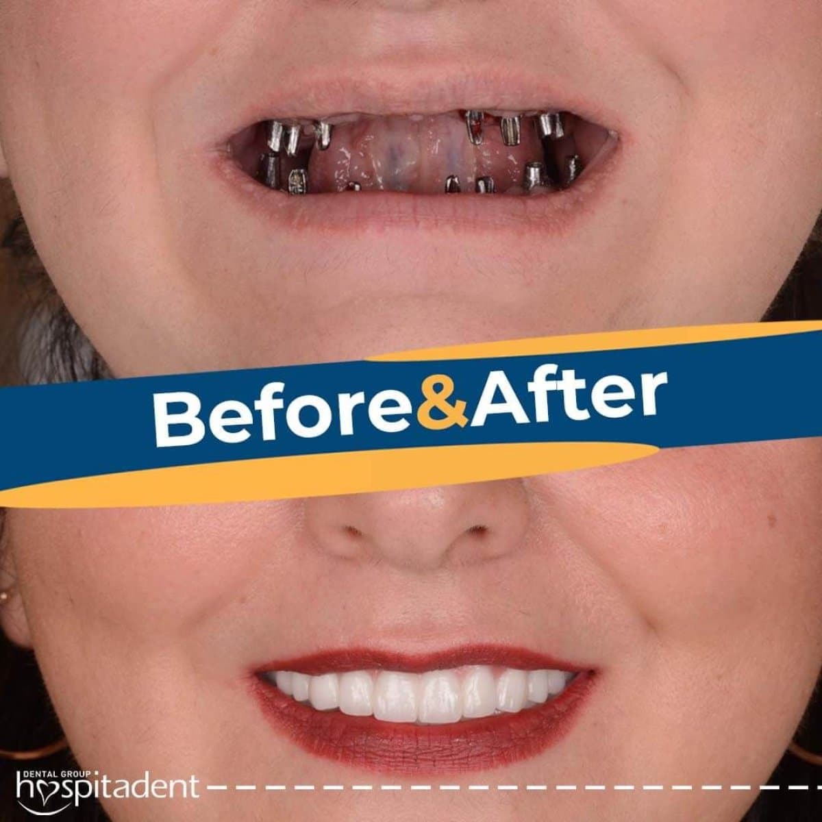 dental implant