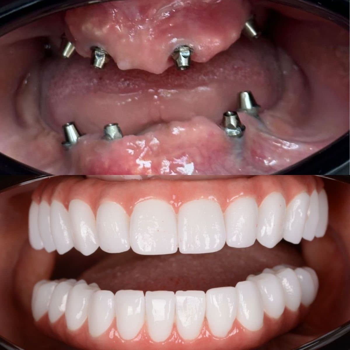dental implant