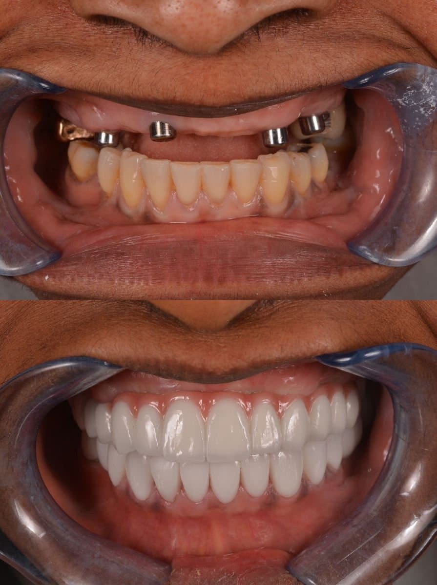 All-on-6 dental implants