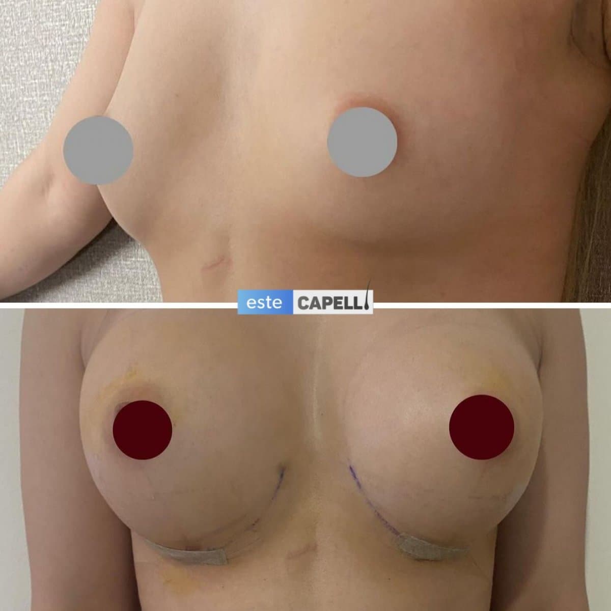 breast augmentation