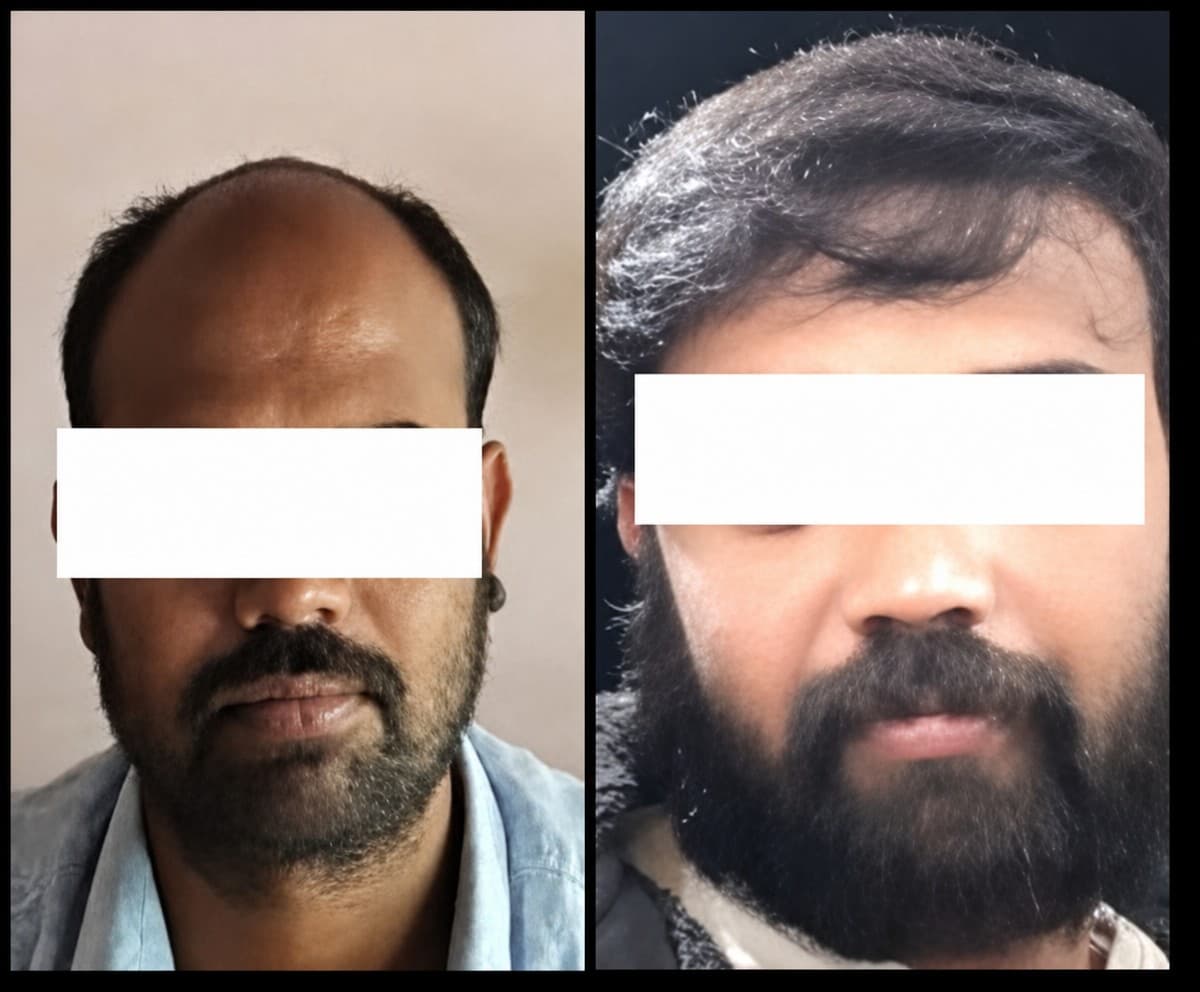 hair transplant