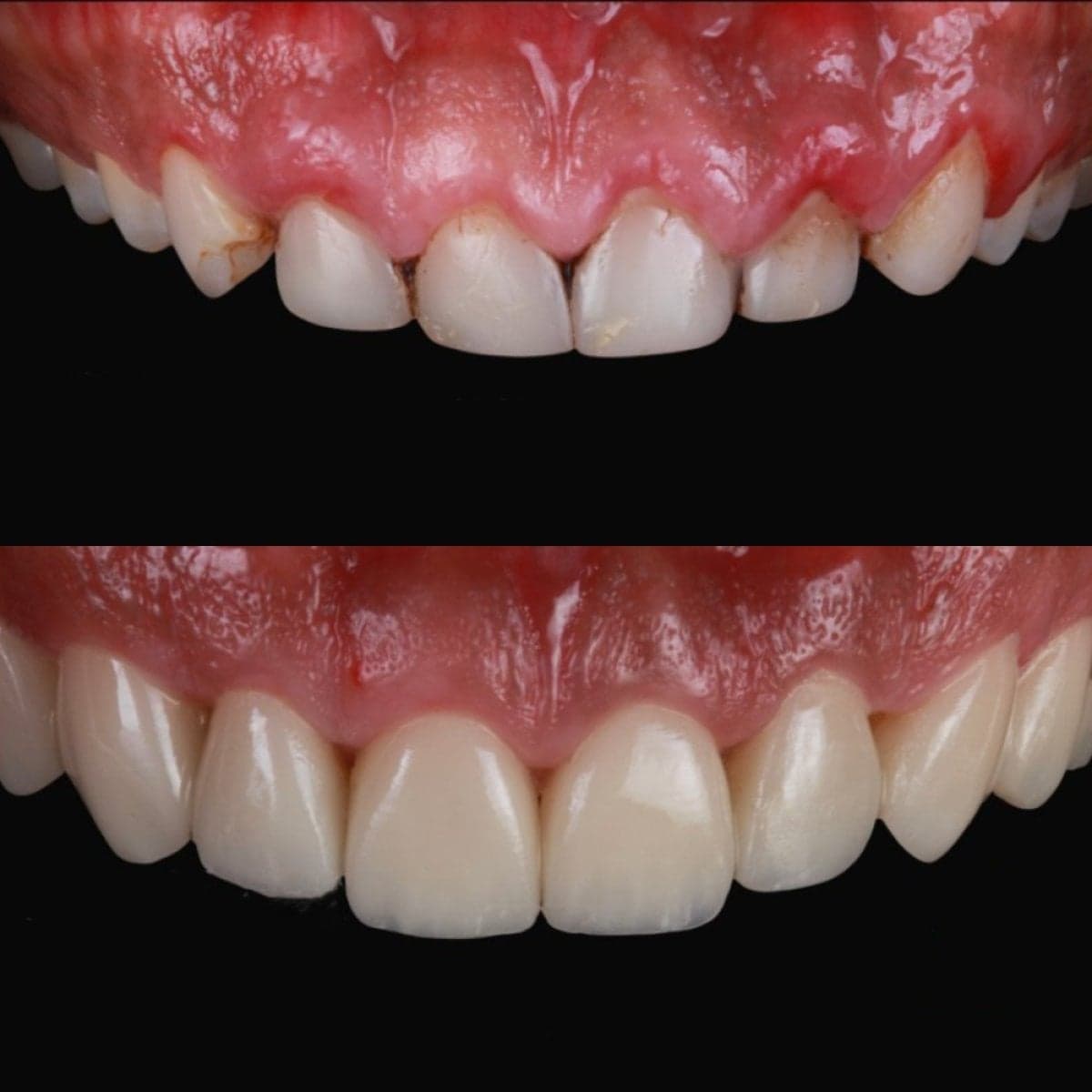 porcelain veneer