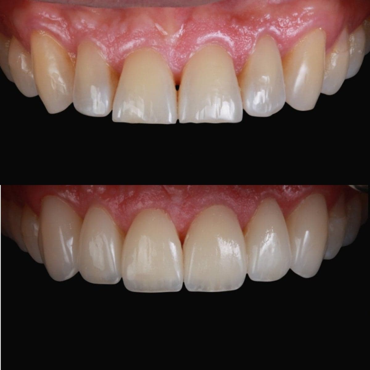 porcelain veneer