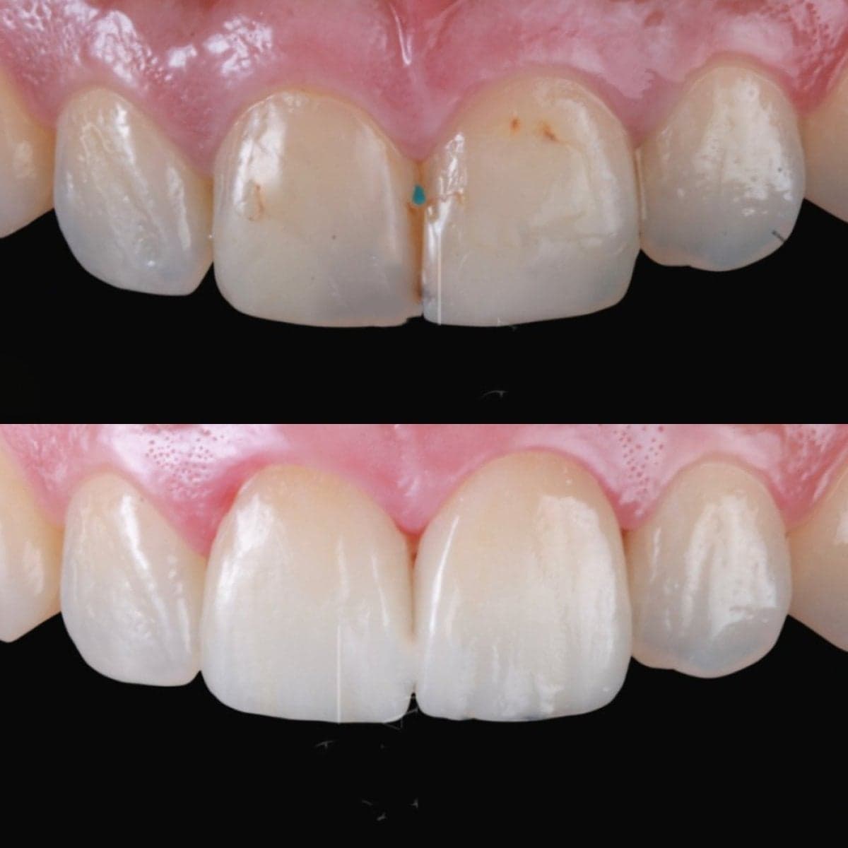 porcelain veneer