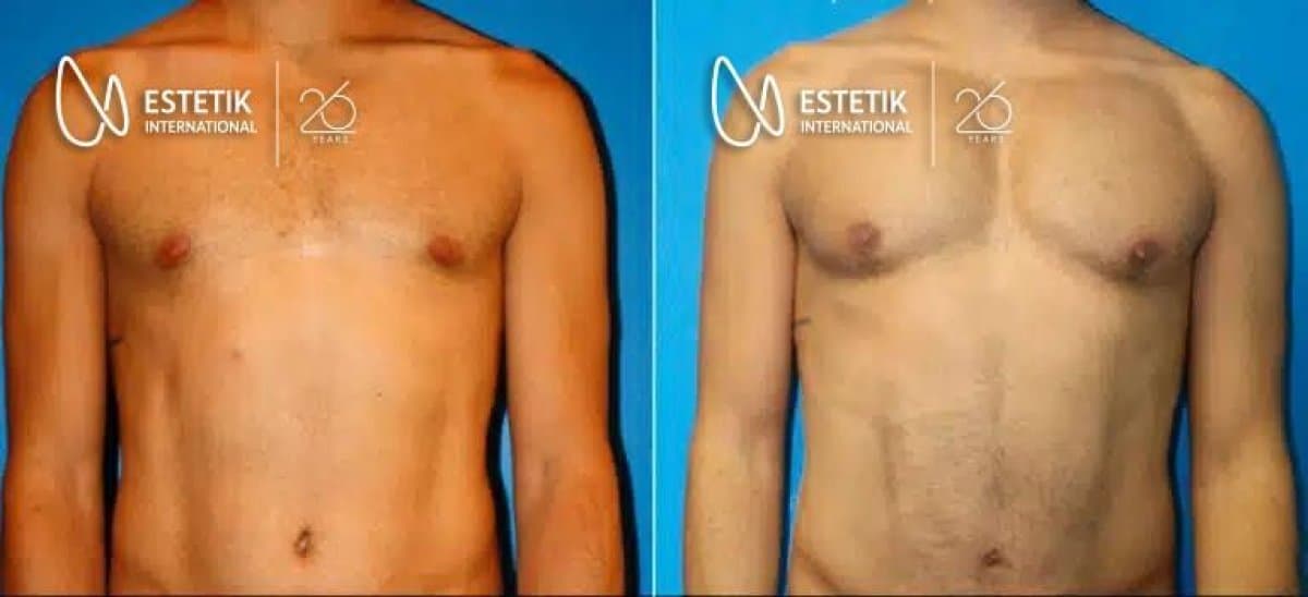 pectoral implants