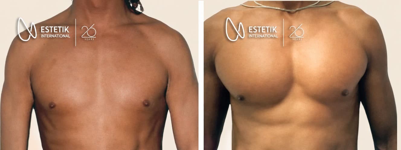 pectoral implants