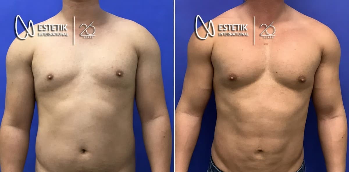 pectoral implants