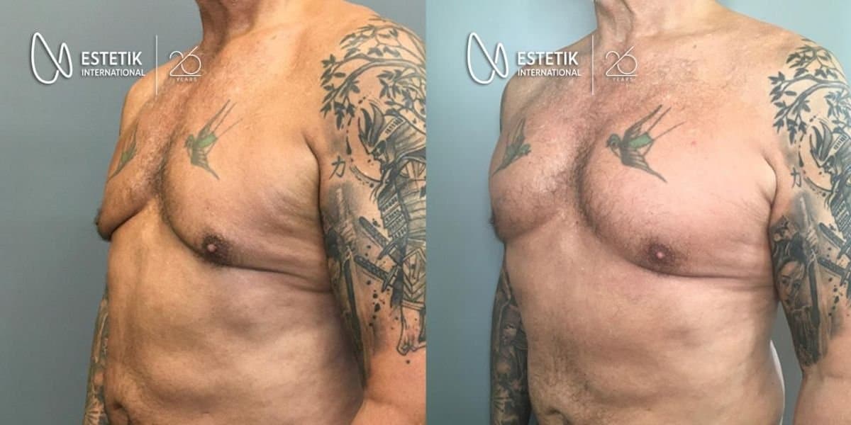 pectoral implants