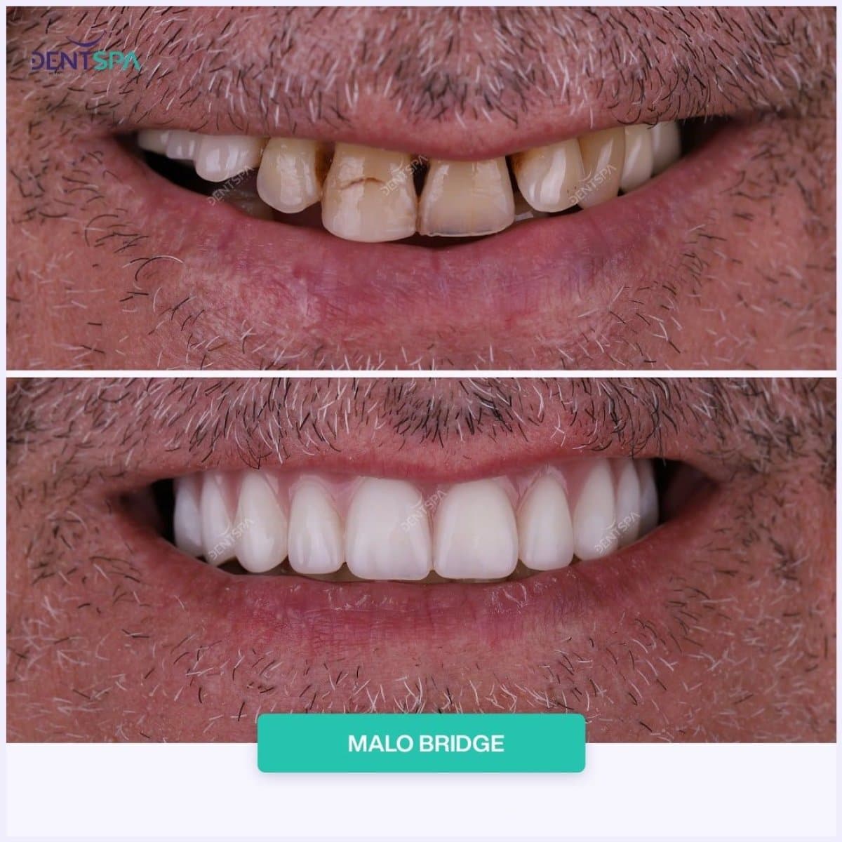 Malo Bridge dental restoration