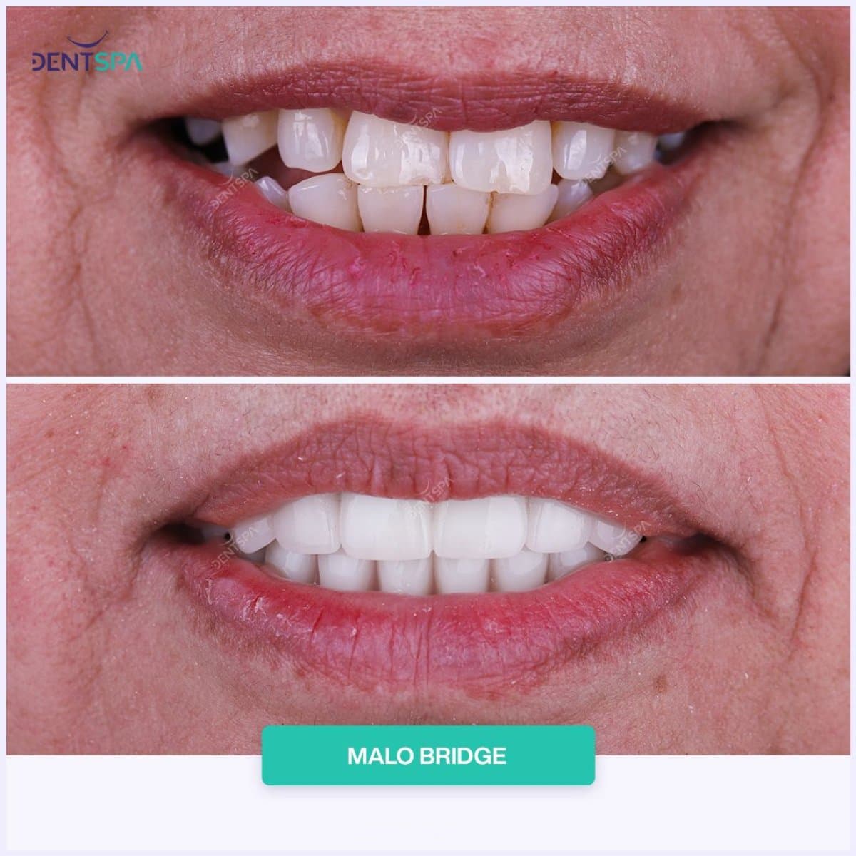 Malo Bridge dental restoration