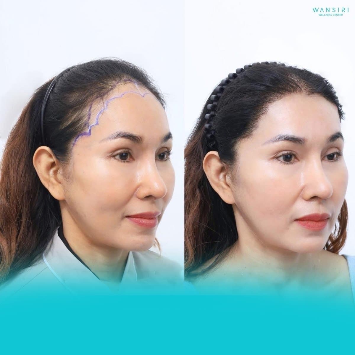 hair transplant