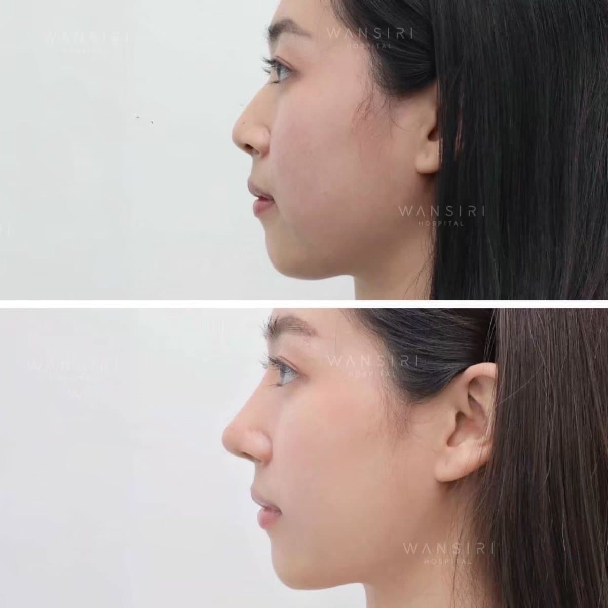 septoplasty