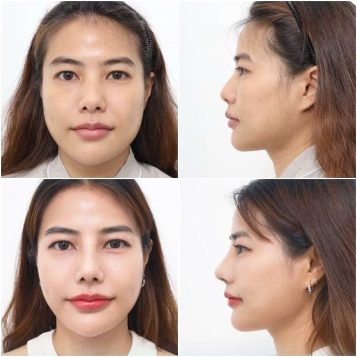 rhinoplasty
