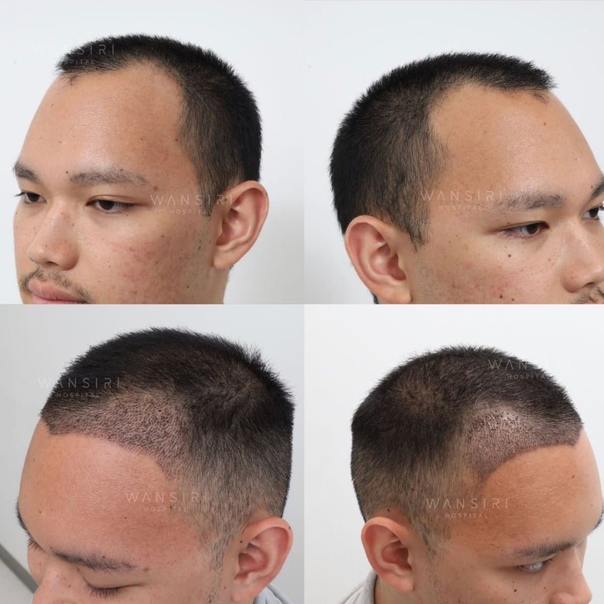 hair transplant