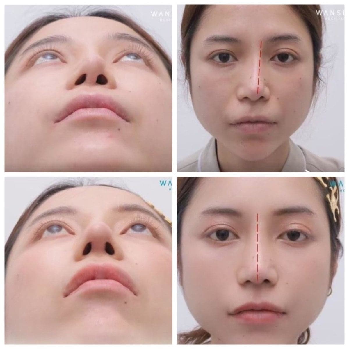 septoplasty