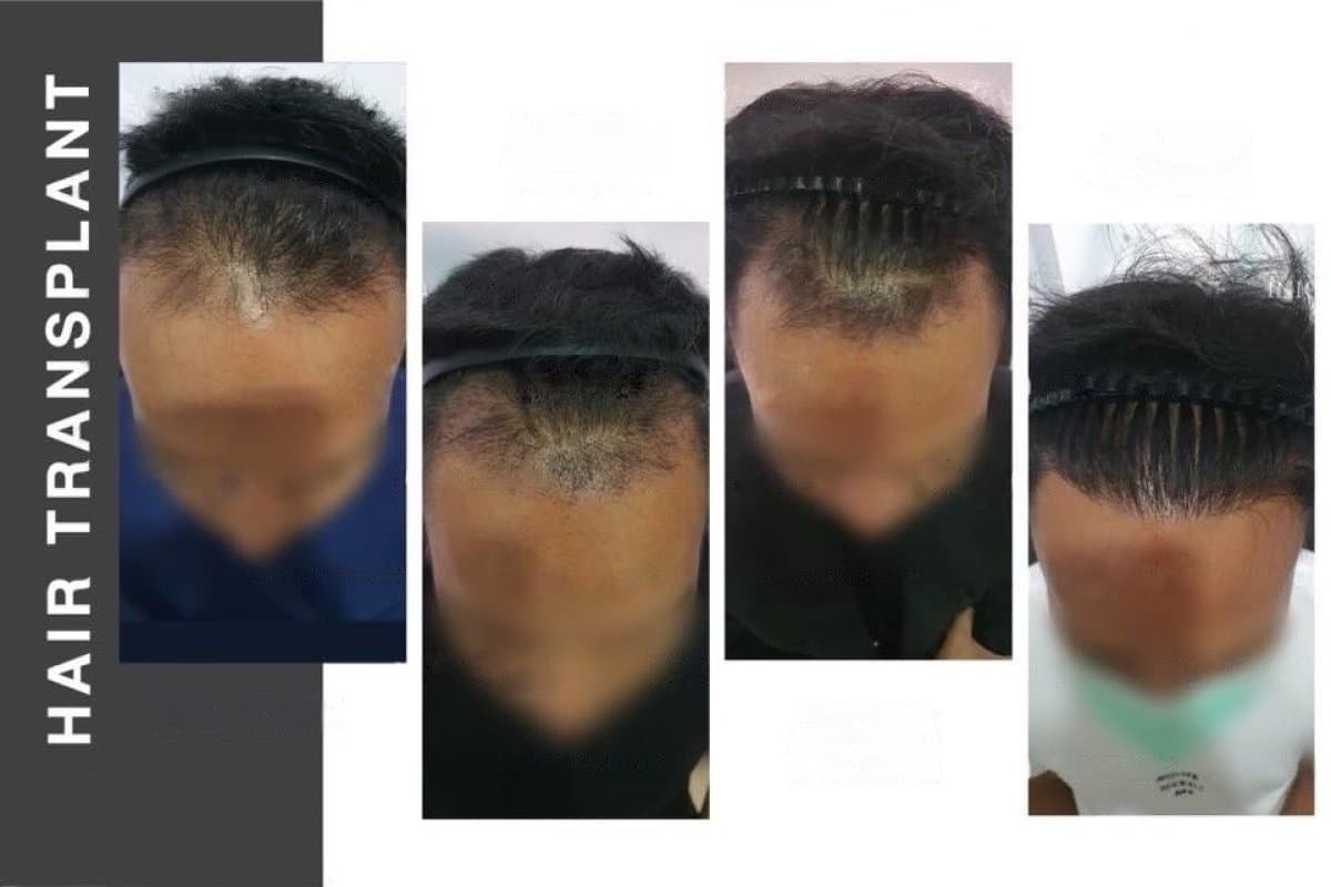 hair transplant