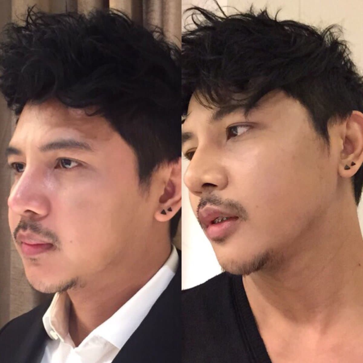 nonsurgical facelift