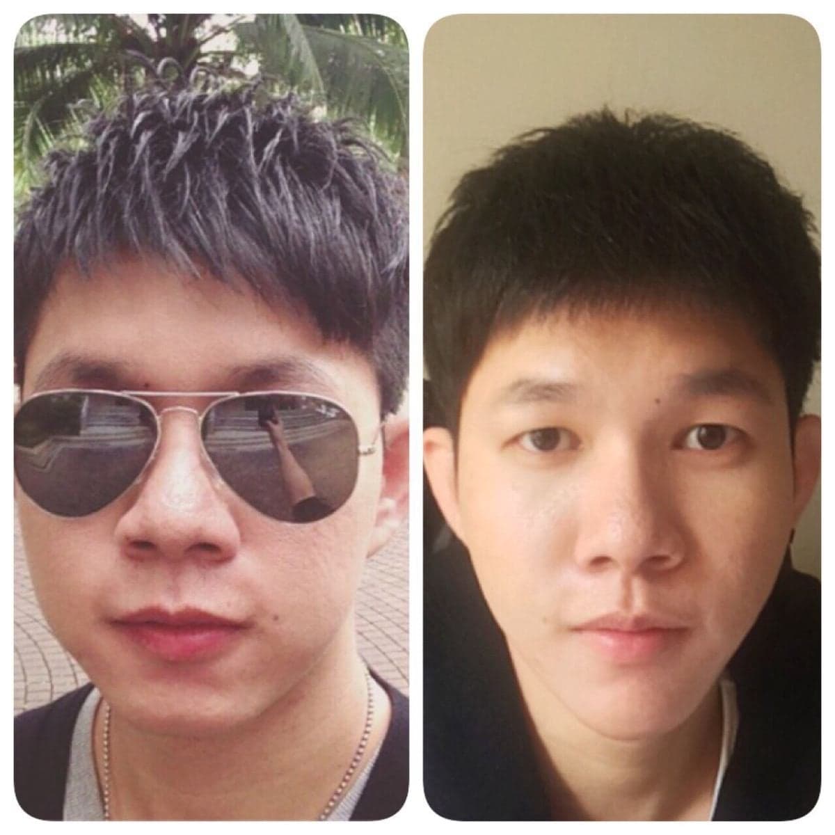 nonsurgical facelift