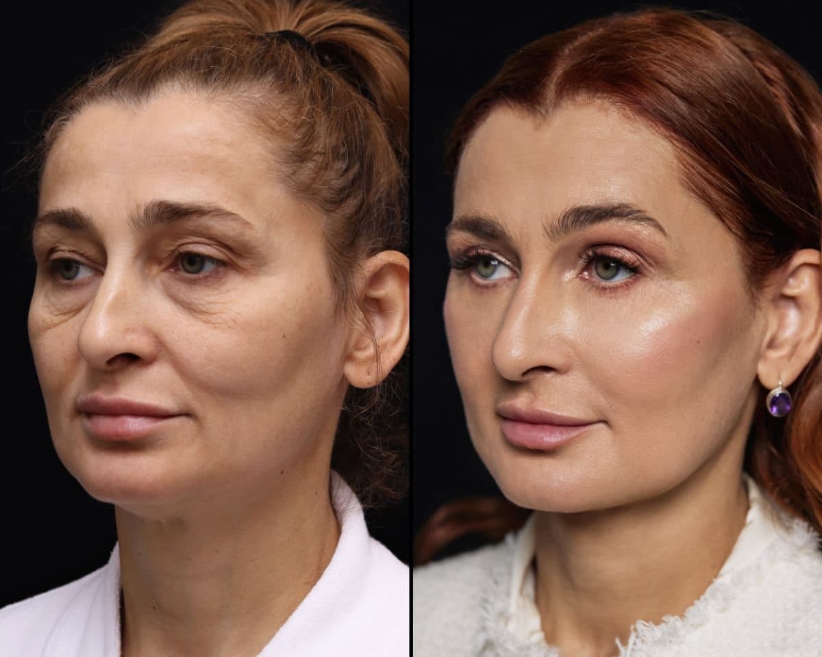 facelift