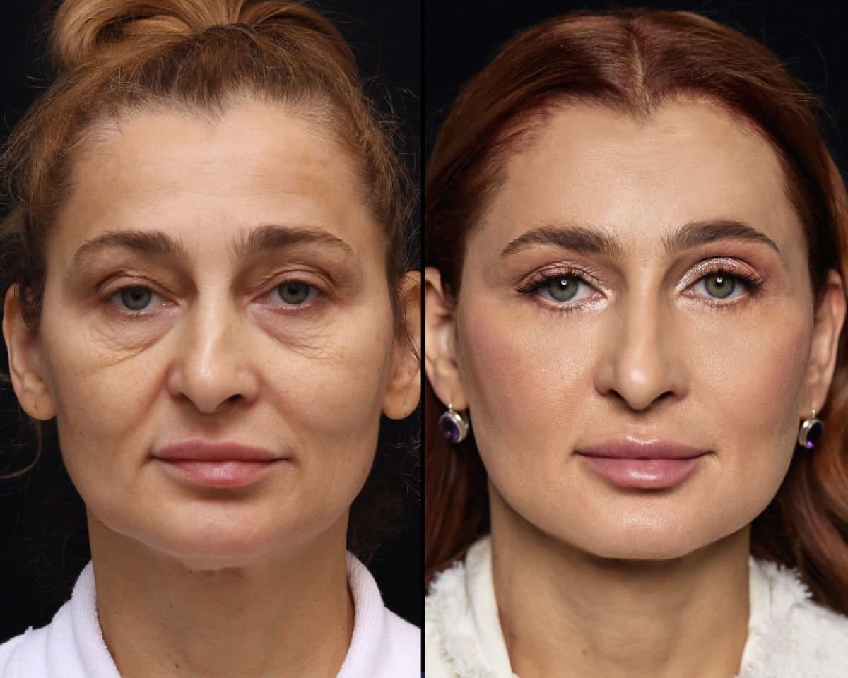facelift