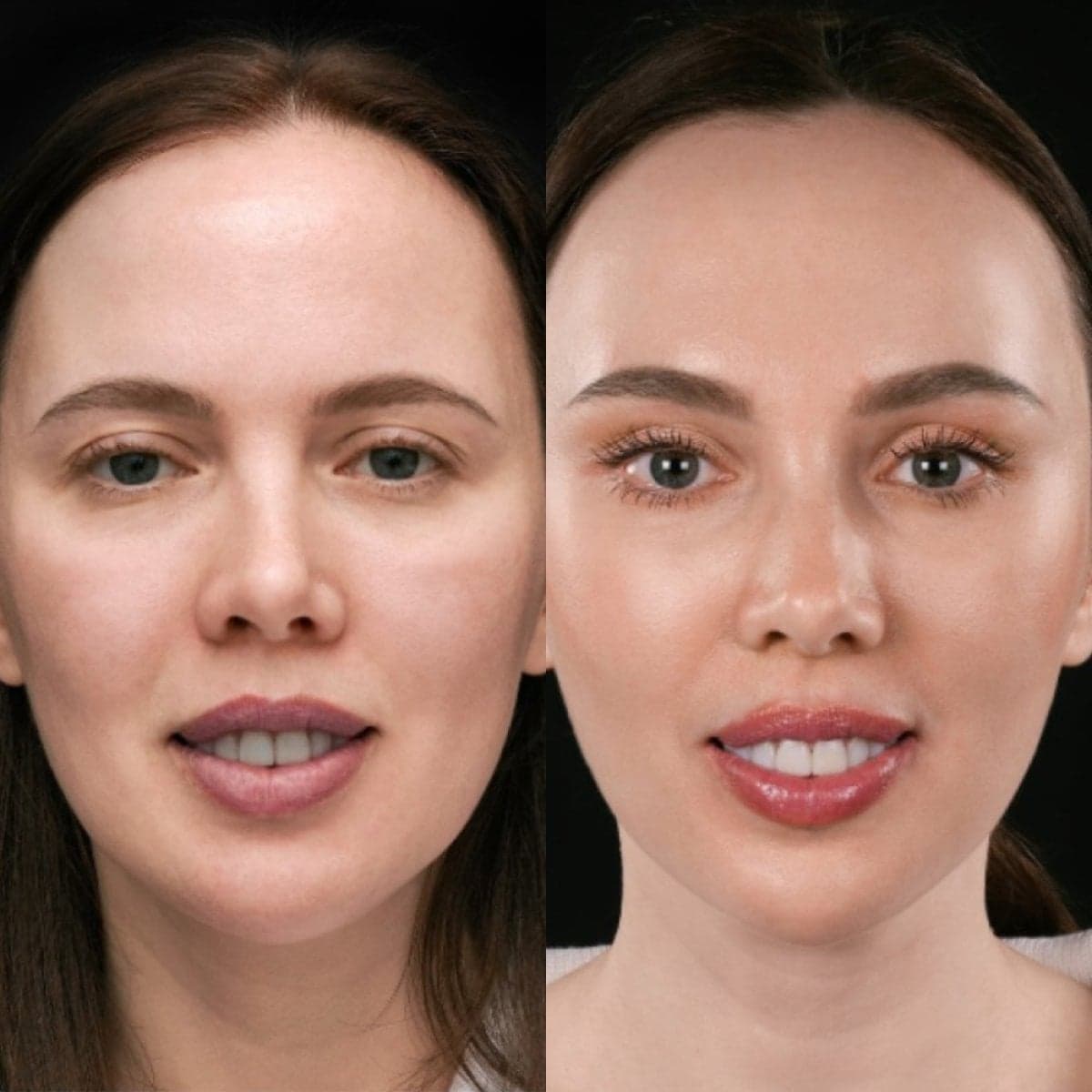 Deep Plane Facelift
