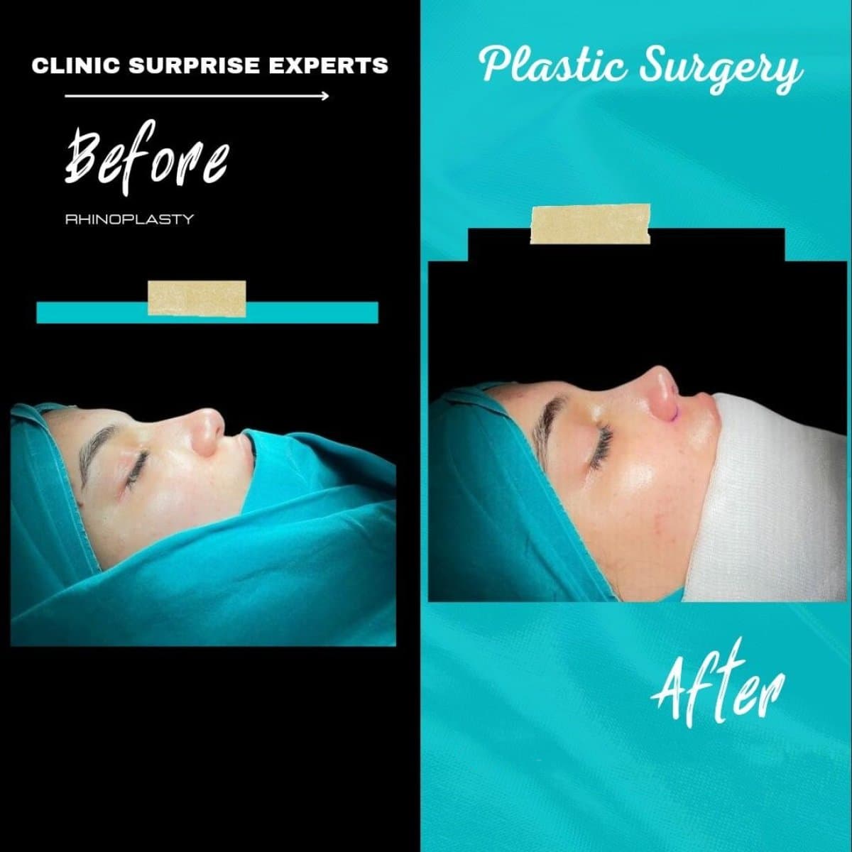 rhinoplasty