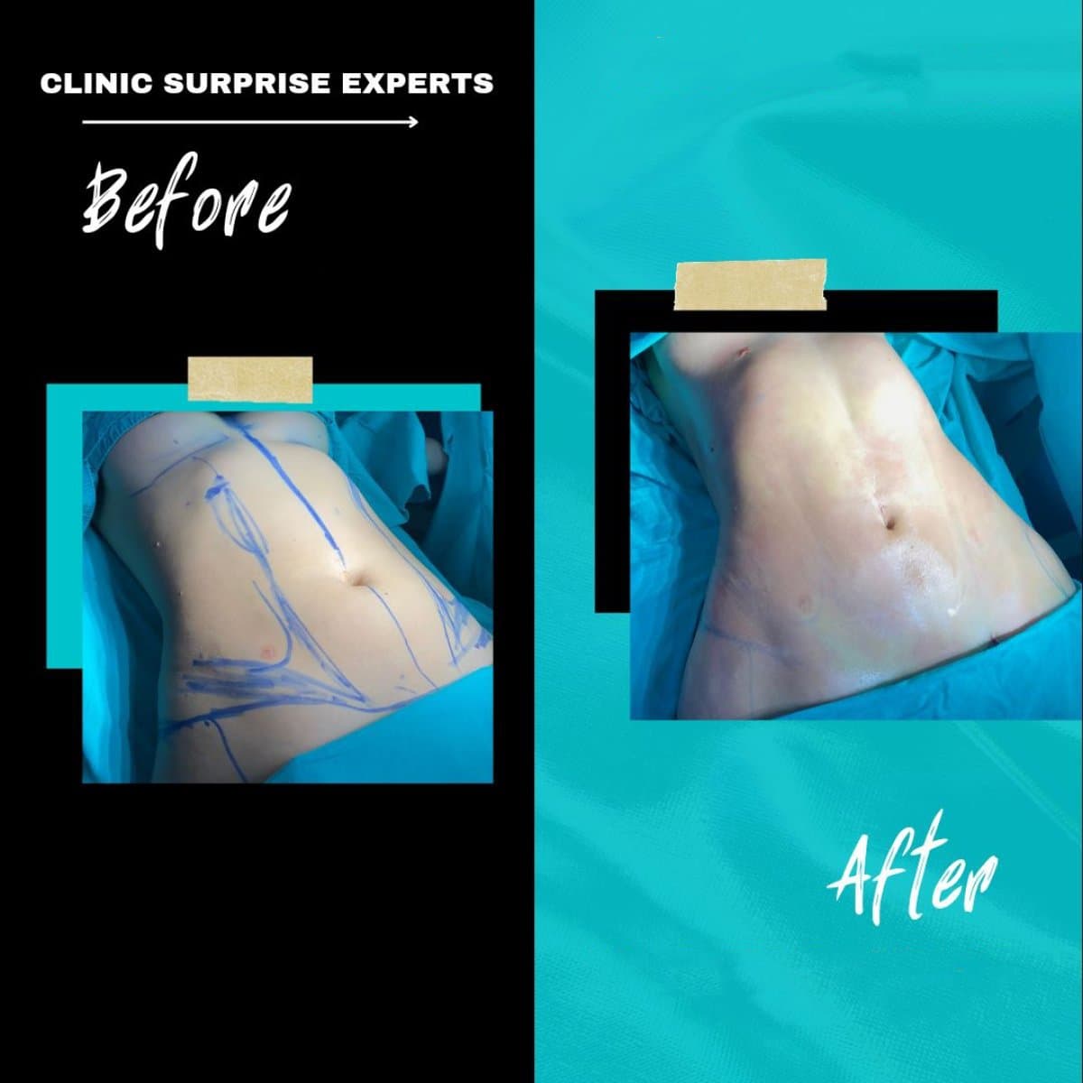 liposuction