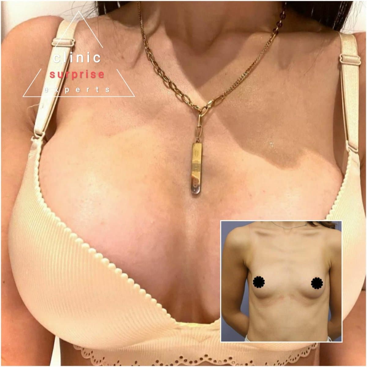 breast implants with lift