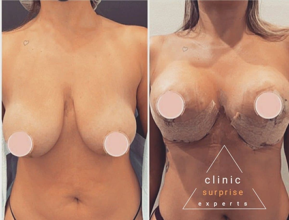 breast reduction