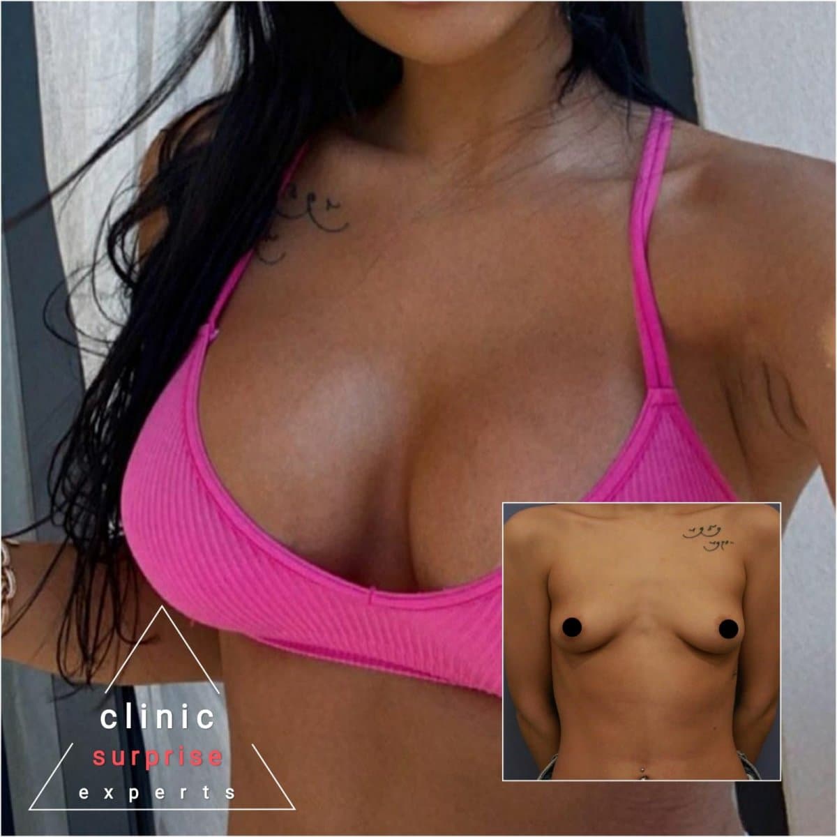 breast implants with lift