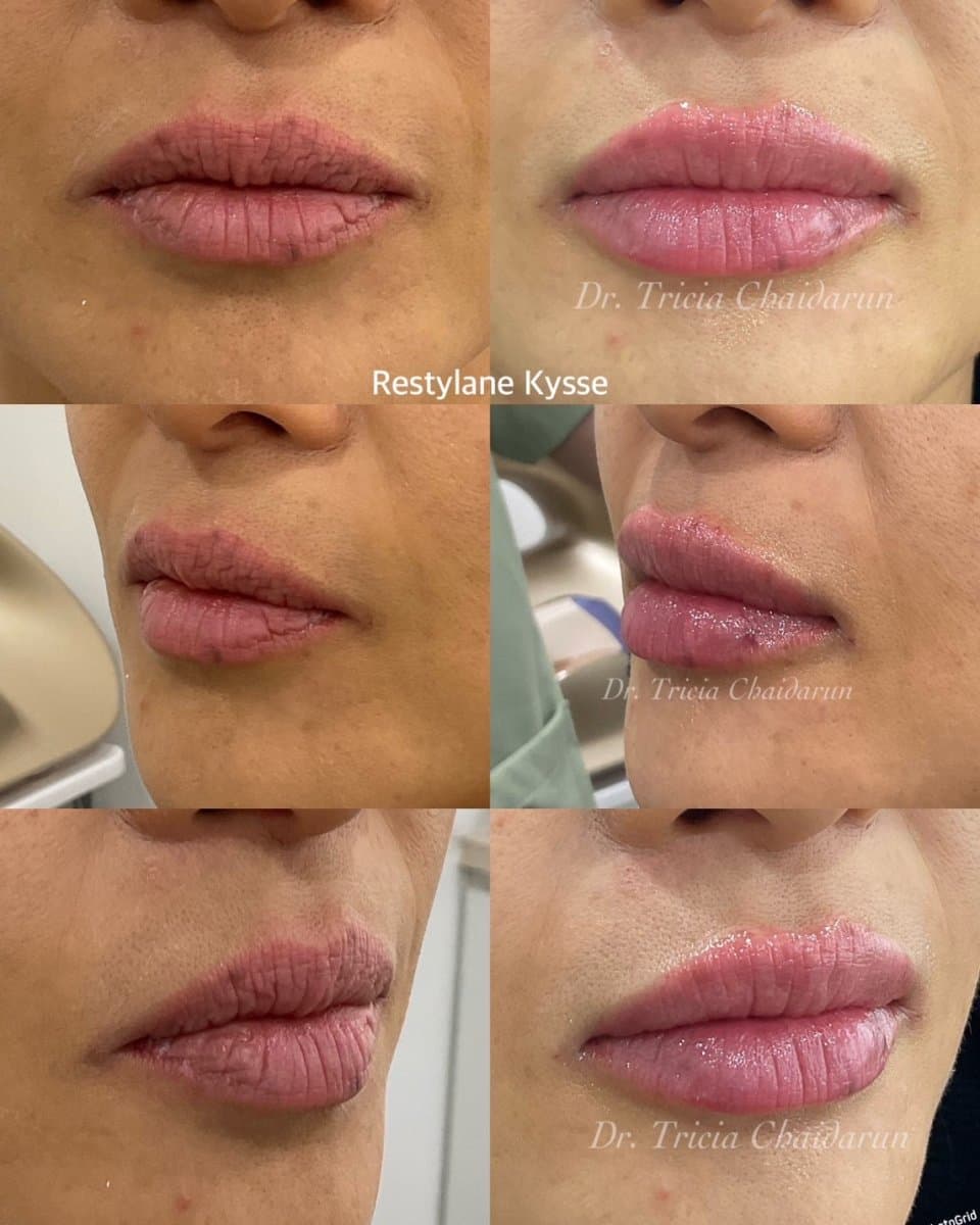 lip fillers injection