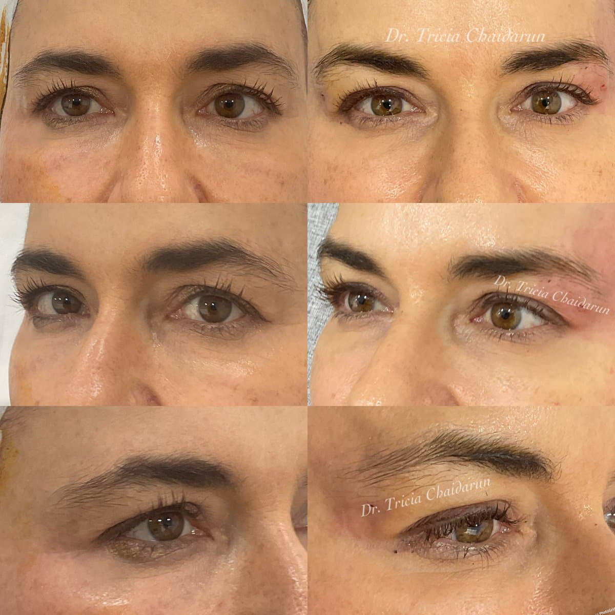 Botox injections