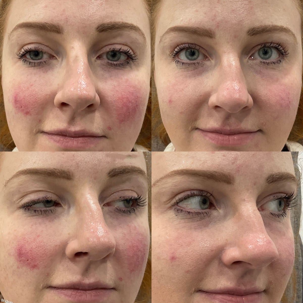fillers injection