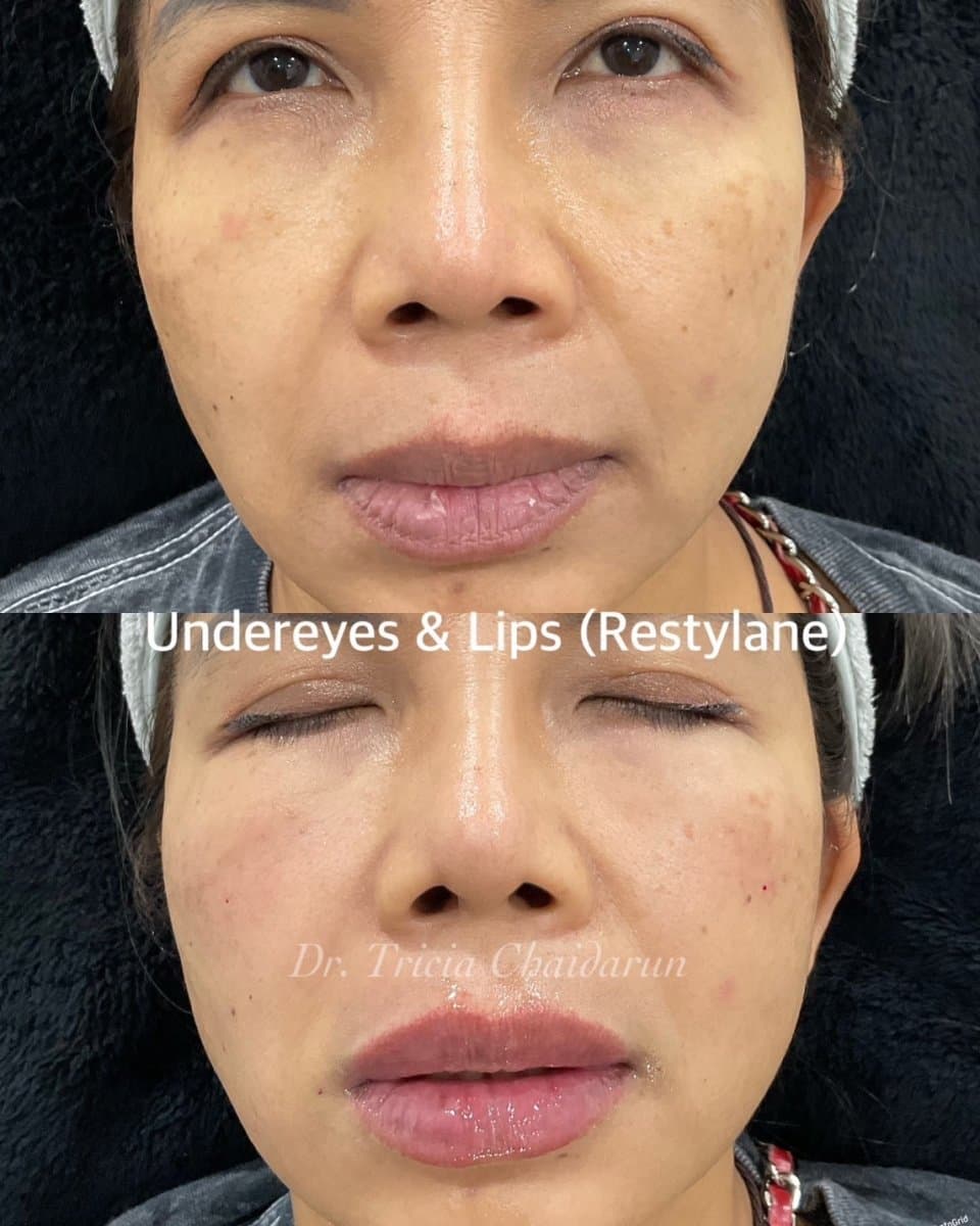 Restylane fillers for undereyes and lips