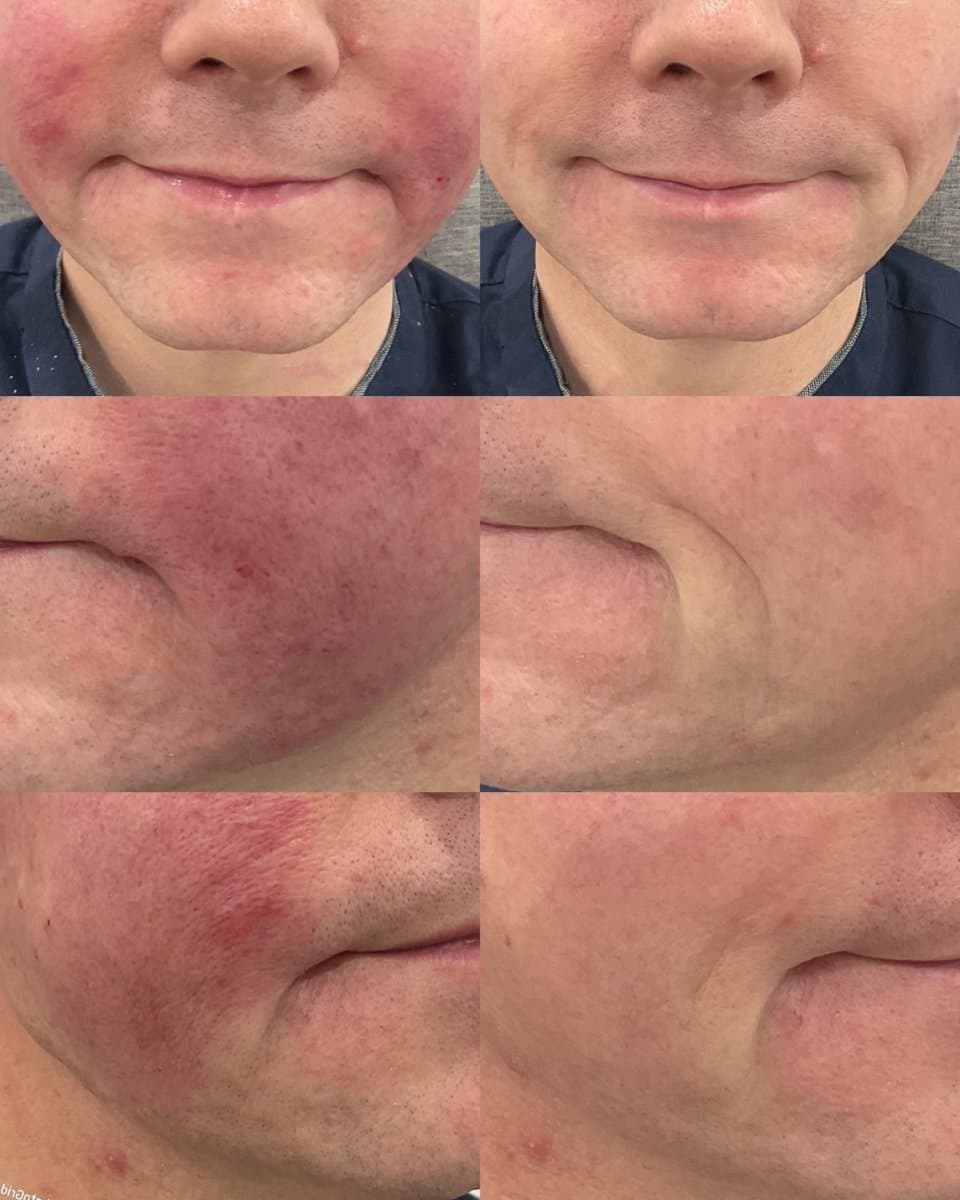 fillers injection