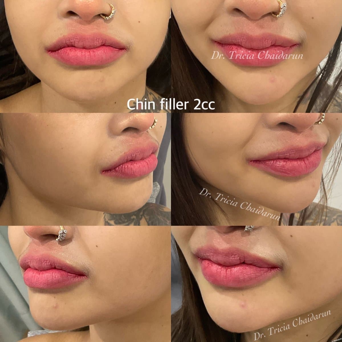 chin filler 2cc