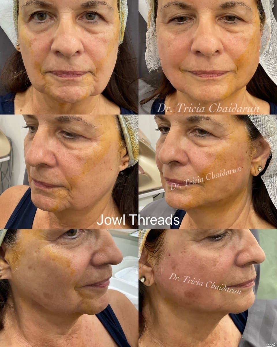 nonsurgical facelift with jowl threads