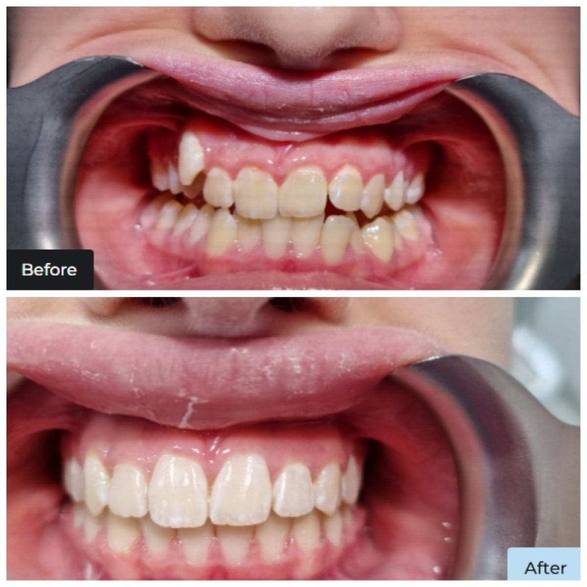 clear aligners