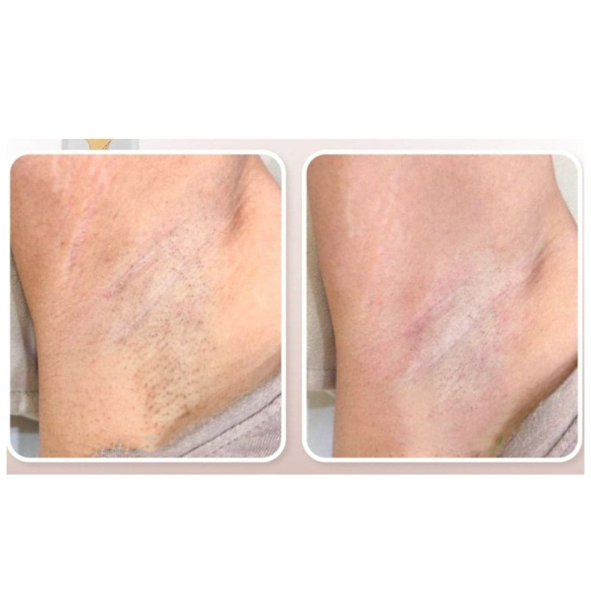 laser hair removal