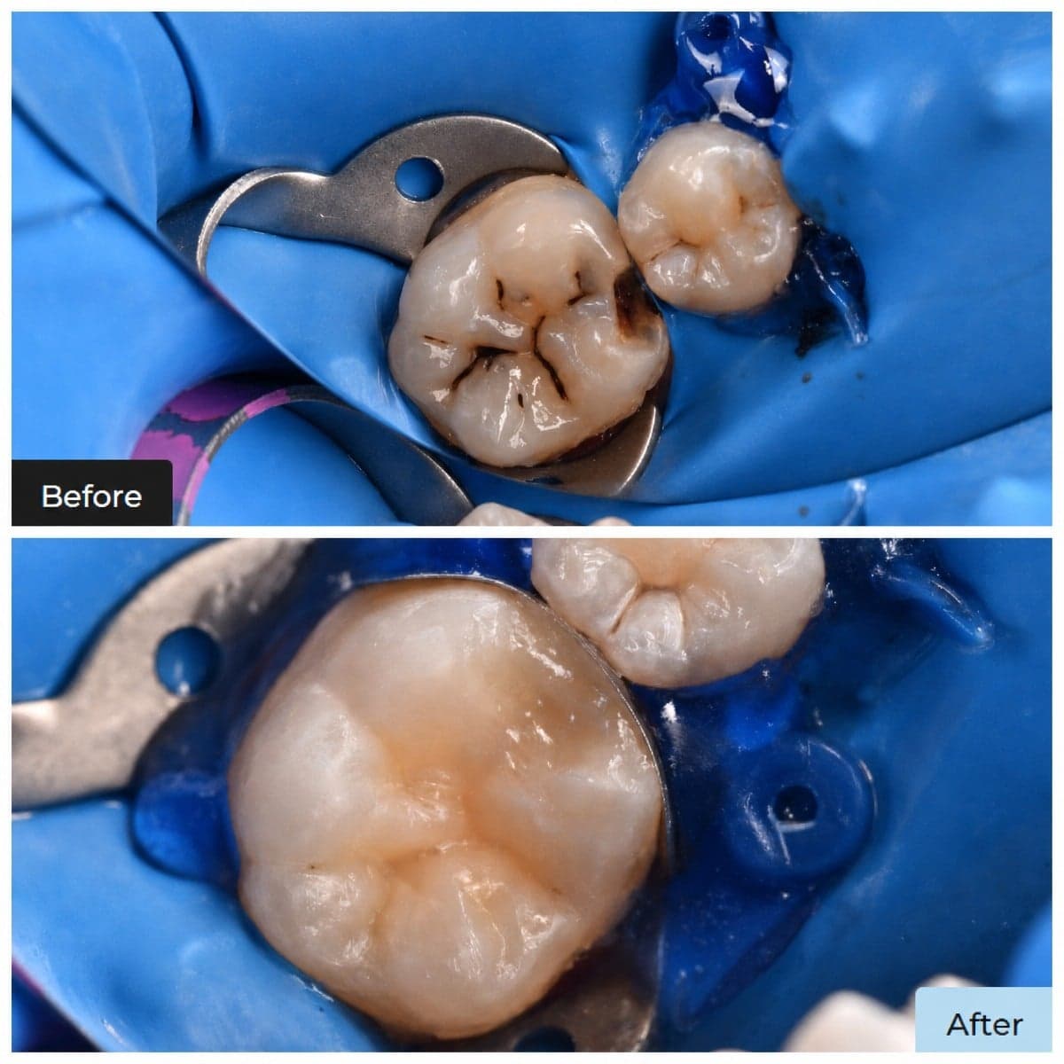 composite filling