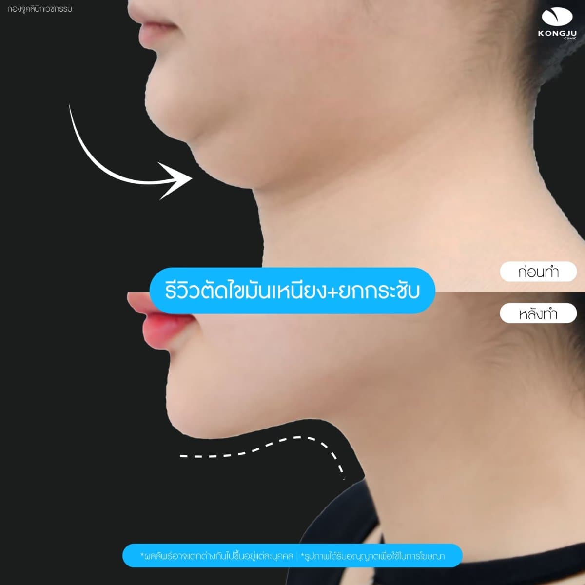 neck liposuction