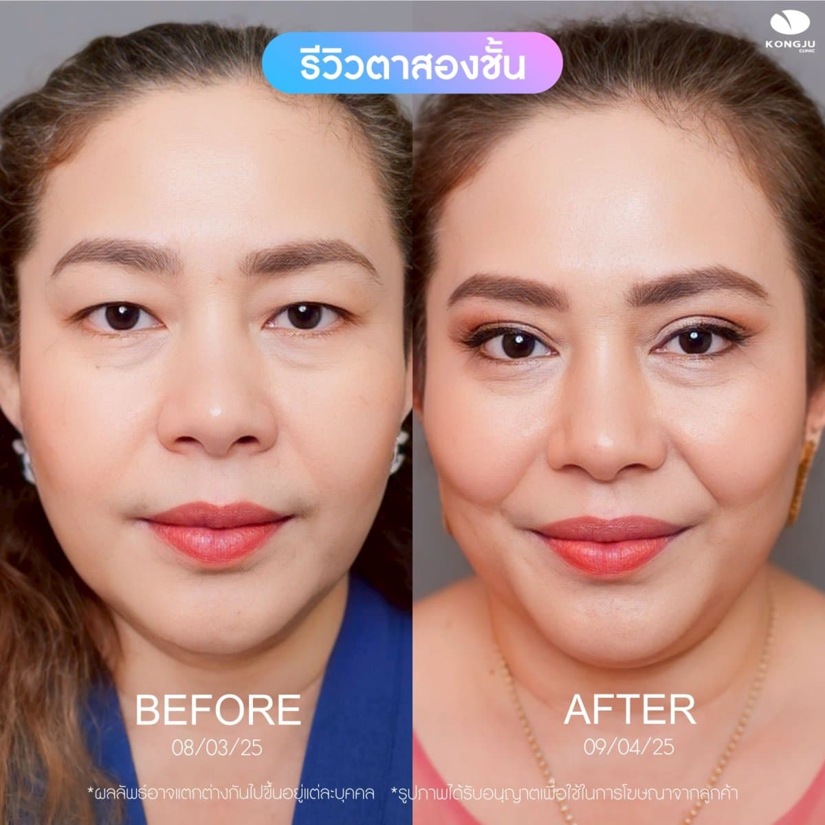 double eyelid surgery