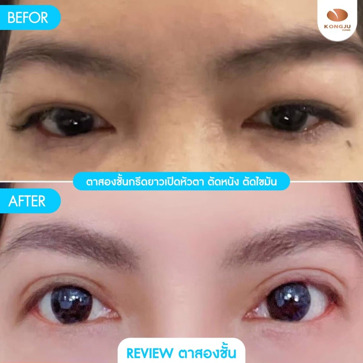 double eyelid surgery