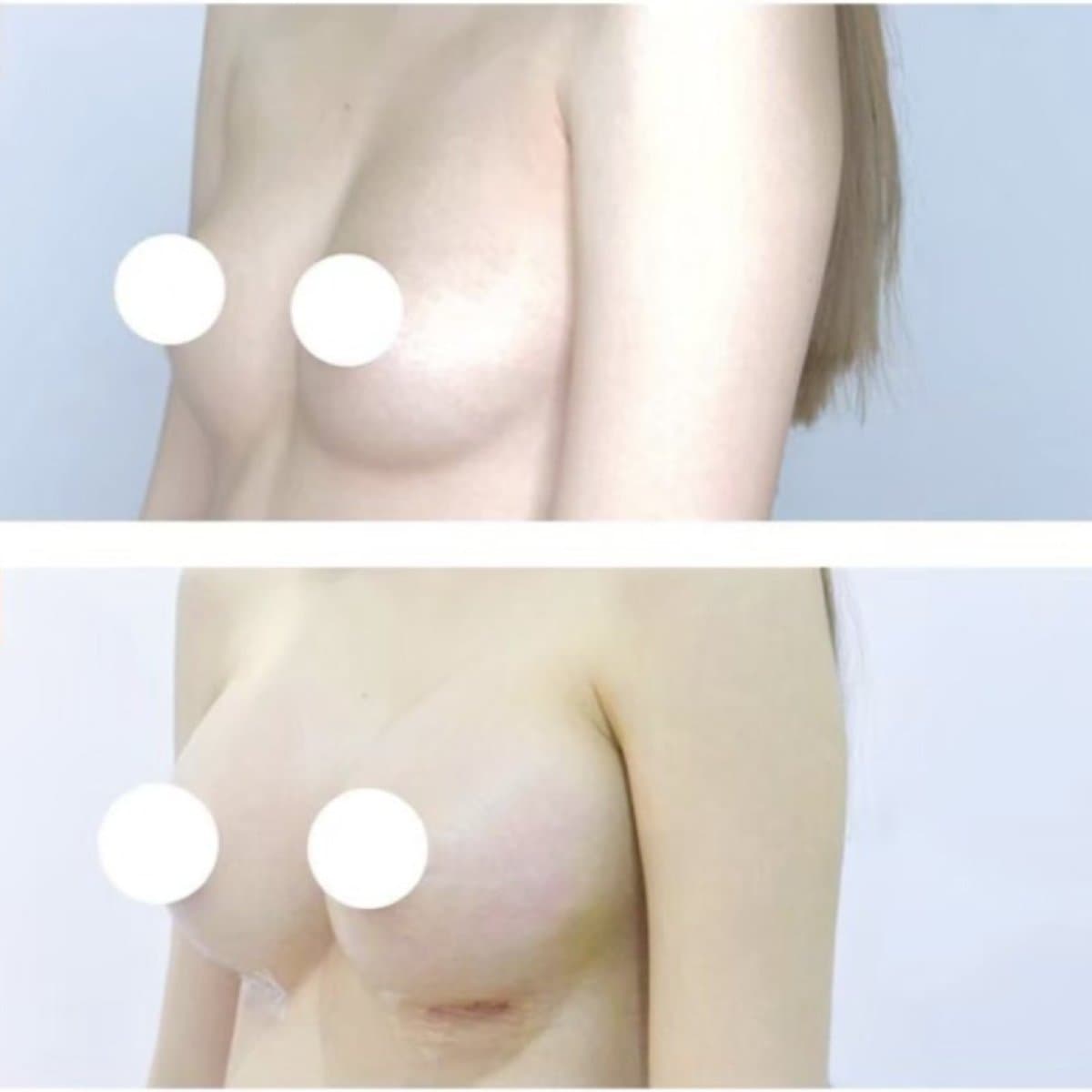 breast augmentation