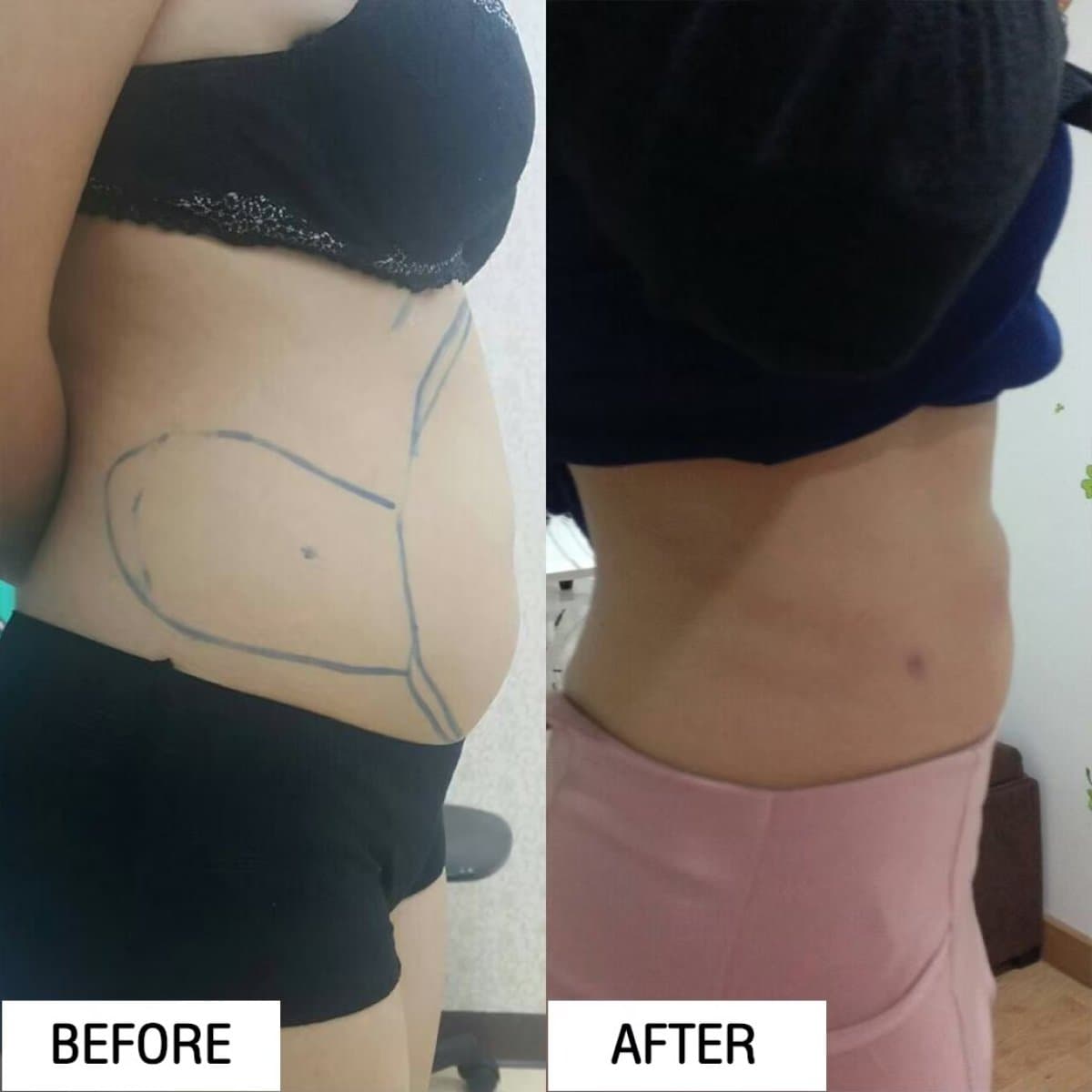liposuction