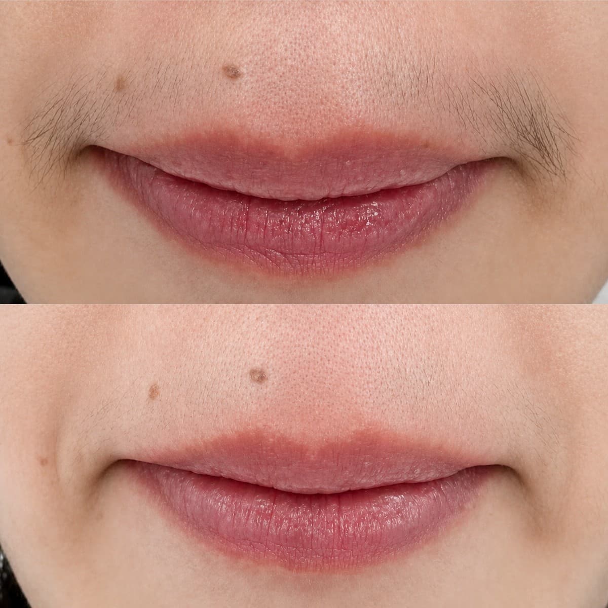 laser hair removal on upper lip
