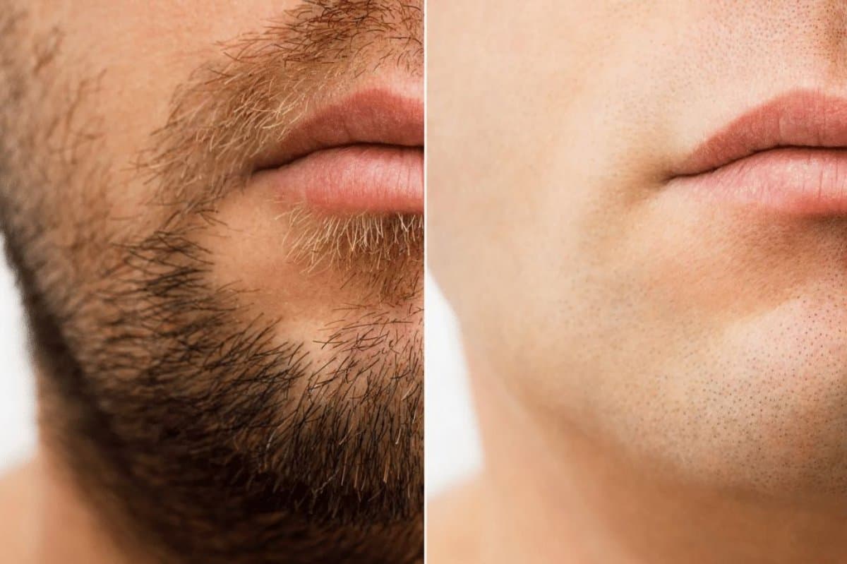 laser hair removal