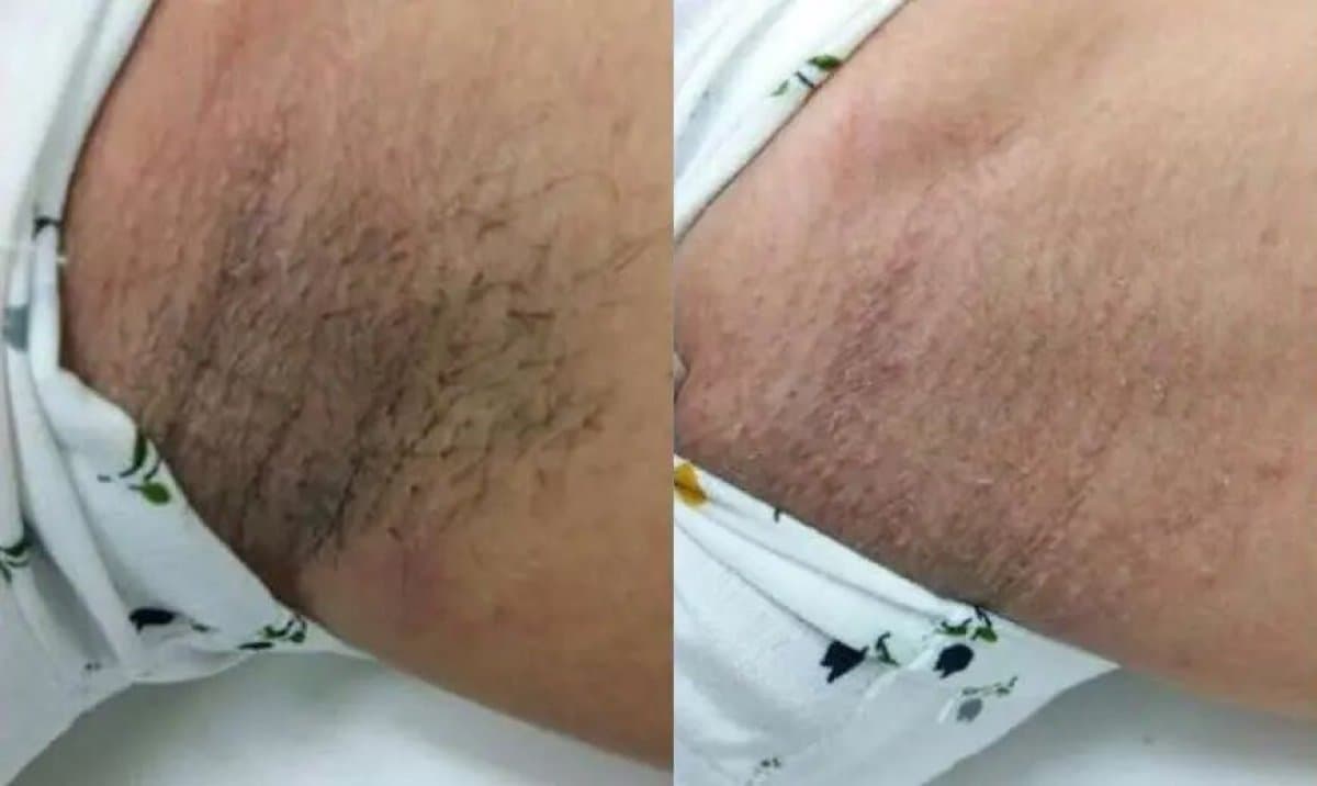 laser hair removal
