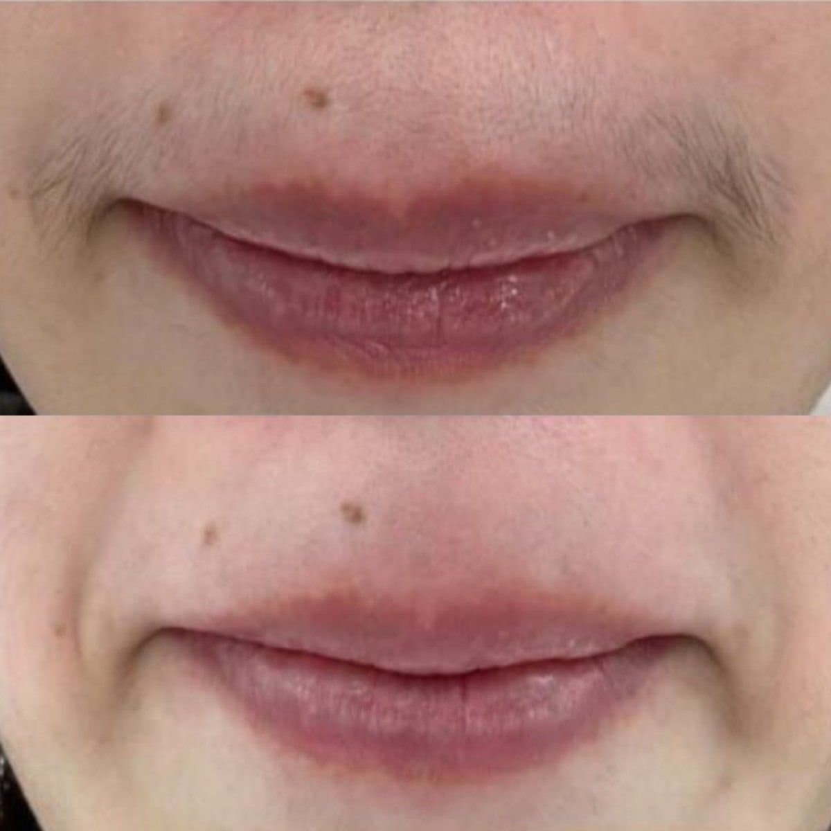 laser hair removal